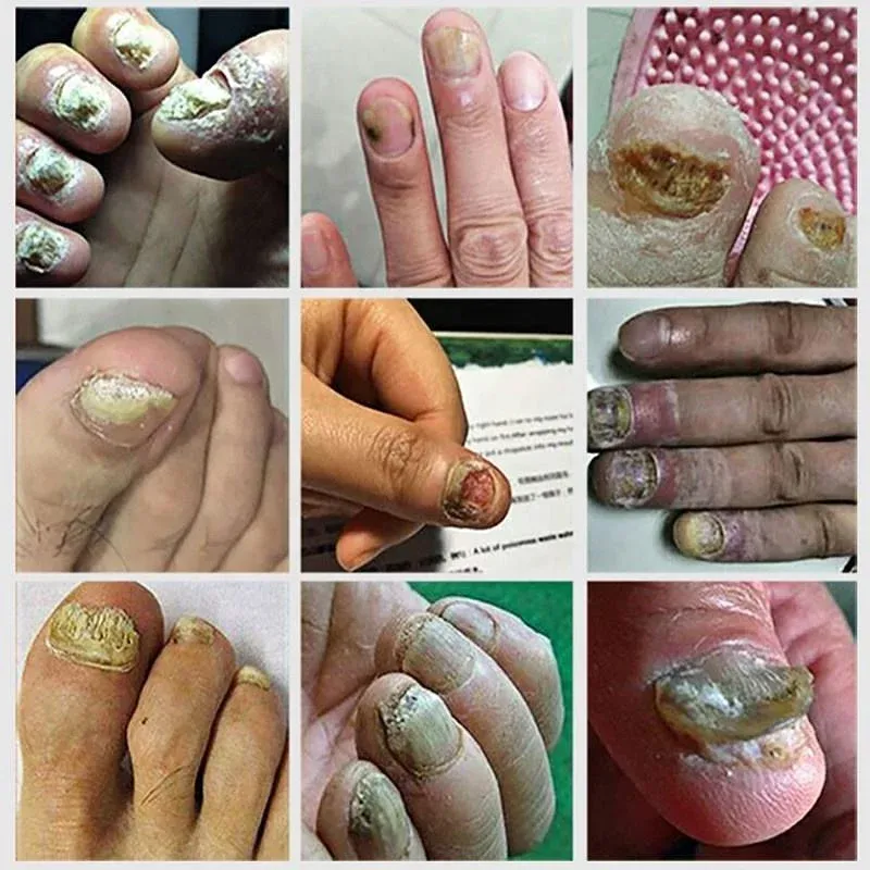 থাম্বনেইল 1
